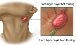 Tăng nguy cơ tử vong ở người ung thư hạch bạch huyết khi dùng ukoniq