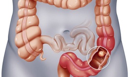 Polyp đại trực tr&#224;ng: Nguy&#234;n nh&#226;n, phương ph&#225;p điều trị v&#224; ph&#242;ng ngừa