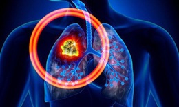 Ung thư phổi: Nguy&#234;n nh&#226;n, yếu tố nguy cơ g&#226;y bệnh v&#224; điều trị
