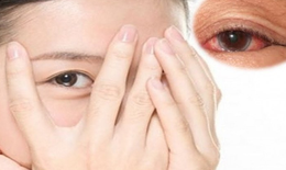 Cảnh giác với chứng đau mắt, đỏ mắt hậu COVID-19