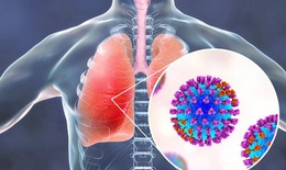COVID-19 có thể gây tổn thương phổi kéo dài