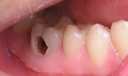 6 b&#224;i thuốc nam đơn giản, dễ kiếm chữa đau răng