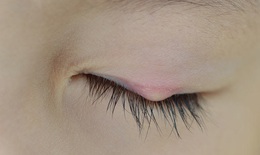 Phòng ngừa lẹo mắt tái phát