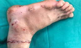Phẫu thuật thành công cho nam thanh niên bị cụt chi do máy cắt cỏ