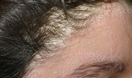 5 biện pháp tự nhiên chữa vẩy nến da đầu