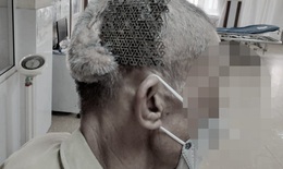 Hy hữu: Người đàn ông nhập viện với tấm Titatium hở trên sọ não