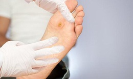 Chăm sóc bàn chân cho bệnh nhân đái tháo đường