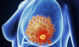 Liệu pháp nội tiết có làm tăng nguy cơ ung thư vú?
