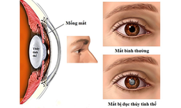 Cách chăm sóc mắt sau mổ đục thủy tinh thể ở người cao tuổi