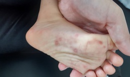 6 lý do khiến bệnh tay chân miệng nguy hiểm với trẻ em
