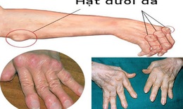 Sử dụng đúng thuốc chống viêm trong điều trị viêm khớp dạng thấp
