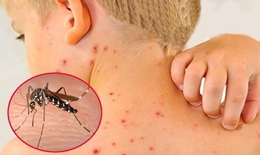 Ca mắc sốt xuất huyết tăng đột biến, nhiều trẻ nhập viện muộn bị ngưng tim, nguy kịch
