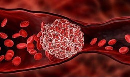 Đông máu hậu COVID-19, cảnh báo từ nghiên cứu của các nhà khoa học gây bất ngờ