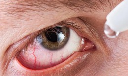 Khô mắt bùng phát: Nguyên nhân, dấu hiệu và cách hạn chế