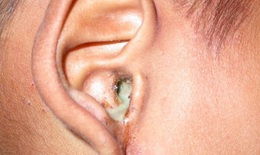 Nhận biết và điều trị nấm ống tai ngoài tránh tái phát