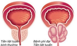 Thuốc chữa u xơ tiền liệt tuyến 