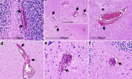 COVID-19 có thể gây viêm và chảy máu não