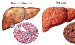 Coi chừng gan nhiễm mỡ có thể gây xơ gan, ung thư gan