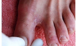 3 bệnh nấm da mùa hè thường gặp và biện pháp điều trị