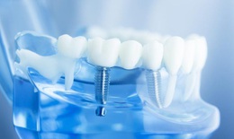 Những biến chứng cực nguy hiểm khi trồng răng Implant