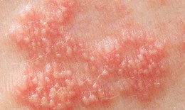 Nhận biết và phòng ngừa Herpes sinh dục
