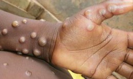 12 quốc gia ghi nhận bệnh đậu m&#249;a khỉ, Việt Nam theo d&#245;i s&#225;t sao, gi&#225;m s&#225;t chặt