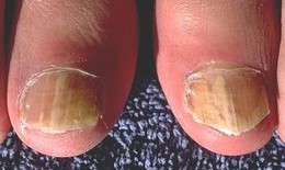 Nấm móng tay và chữa trị dứt điểm