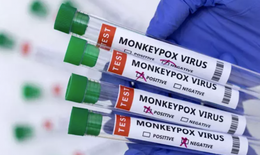 Bệnh đậu mùa khỉ: Bất kỳ ai cũng đều có thể mắc bệnh