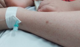 Chăm sóc trẻ mắc sốt xuất huyết tại nhà như thế nào?