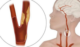 Hiểu về thiếu máu não thoáng qua (TIA) và cách điều trị