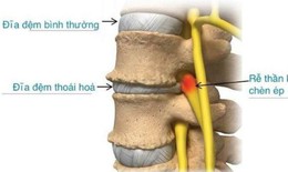 Liệu pháp tiêm hydrogel - lựa chọn mới trị đau lưng do thoái hóa đĩa đệm