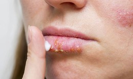 Lưu ý khi dùng các thuốc chữa bệnh chốc