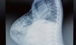 Phẫu thuật thành công cho bệnh nhi 4 tuổi người Lào bị thoát vị thành bụng lớn kèm dị tật ruột xoay 

