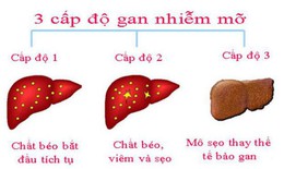 Báo động về bệnh gan nhiễm mỡ