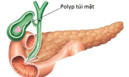 Cảnh giác polyp túi mật có nguy cơ chuyển thành ung thư