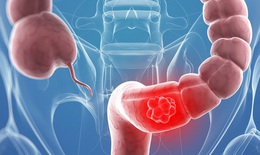 Liệu pháp mới có thể điều trị ung thư trực tràng