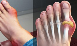 Bệnh gút (gout) là gì? Triệu chứng, chẩn đoán và cách điều trị