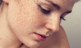 3 bài thuốc phòng trị nám da ở tuổi trung niên