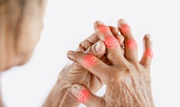 Gout l&#224; g&#236;? Triệu chứng v&#224; c&#225;ch điều trị gout
