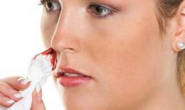 Sơ cứu chảy máu mũi đúng cách từ chuyên gia tai mũi họng
