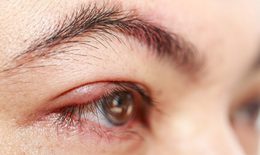 C&#225;c bệnh nhiễm tr&#249;ng ở mắt thường gặp