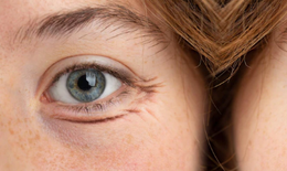 5 cách khắc phục quầng thâm dưới mắt hiệu quả tại nhà