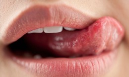 Viêm da quanh miệng: Các dạng tổn thương và cách chữa trị