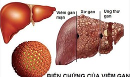 Khoảng 8,8 triệu người Việt bị căn bệnh 'diễn biến thầm lặng nhưng hậu quả rất nghiêm trọng'