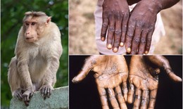 TP.HCM triển khai các giải pháp giám sát, ứng phó với dịch đậu mùa khỉ