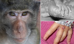 Hơn 16.000 người trên thế giới mắc bệnh đậu mùa khỉ, Bộ Y tế khuyến cáo 6 biện pháp phòng chống 