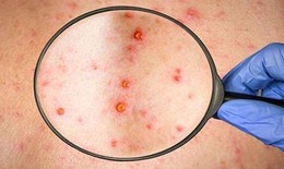 Đậu mùa khỉ có thể xâm nhập vào Việt Nam nhưng khó thành đại dịch