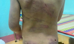 Vụ bé gái 7 tuổi bị bạo hành: Bị cha dượng đánh dã man vì làm đổ cơm khi ăn