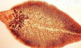 Nghiện gỏi coi chừng mắc sán lá gan