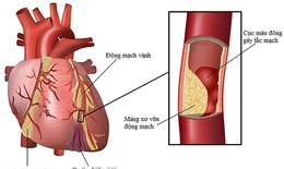 Cách nhận biết viêm cơ tim và phương pháp điều trị